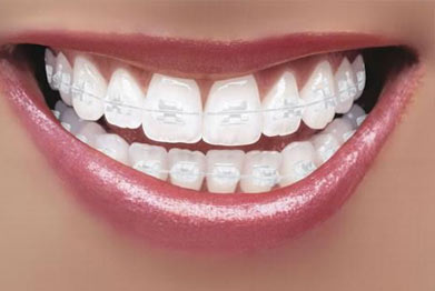 Clear Braces in St Albans